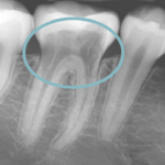 Teeth Root-Resorption - Dental problem