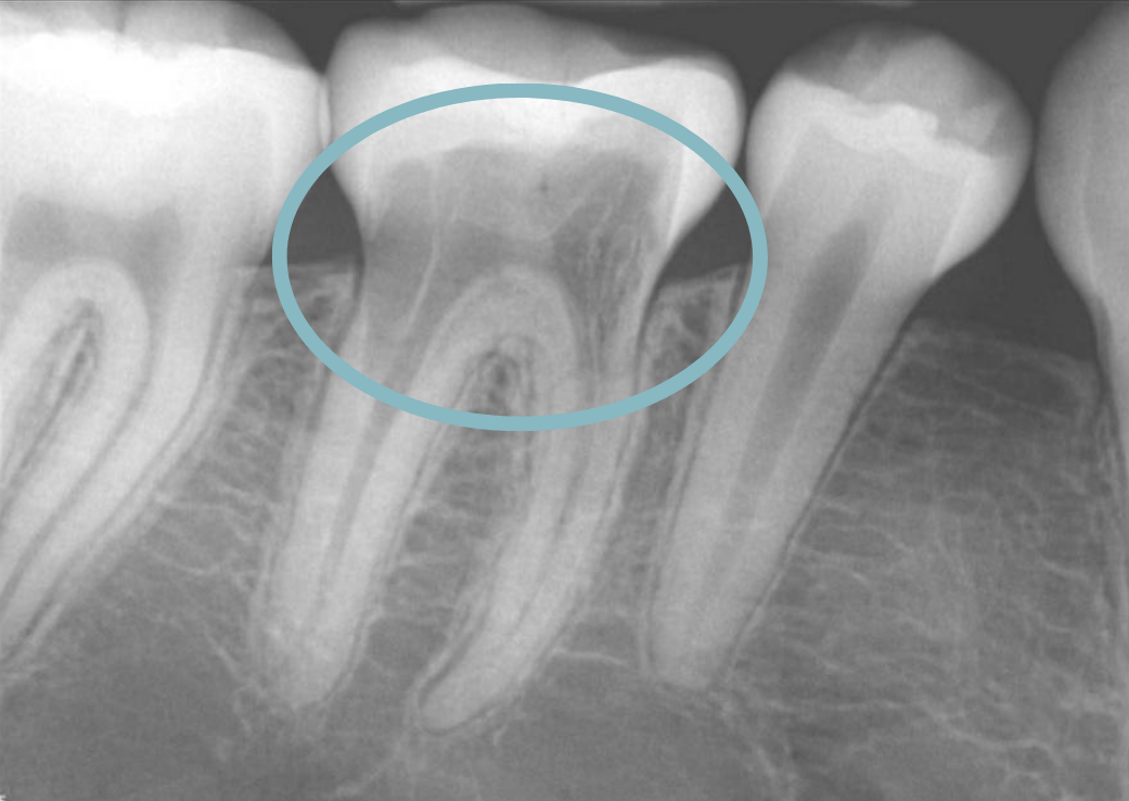 Teeth Root-Resorption