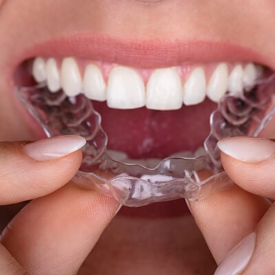 Invisalign by dentist in Sumner, dentist near me