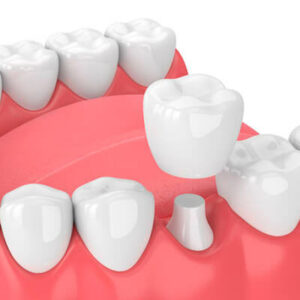 Dental-Crowns-3D-Illustration