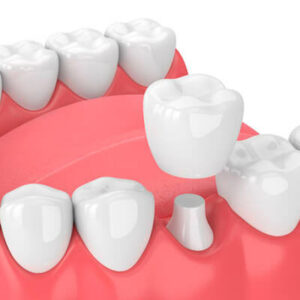 Dental-Crowns-3D-Illustration - Dental Crowns