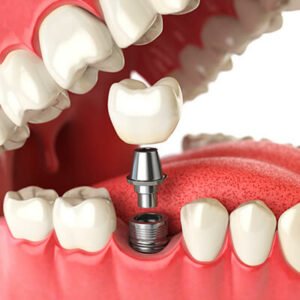 Dental-implant-3D-illustration