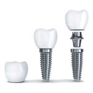 Dental-implants-illustration