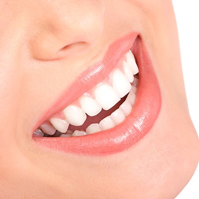 Teeth Whitening Smile