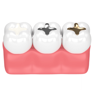 dental-implants-color - Fillings - Dental fillings