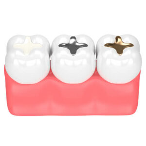 dental-implants-colors-gold-silver-white