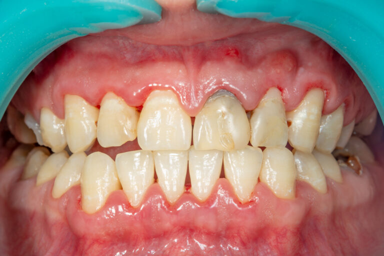 deep-cleanings-stop-bone-loss-due-to-periodontal-disease-jennifer