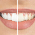 Tips for Teeth Whitening Before- and-after-smile-half-and-half