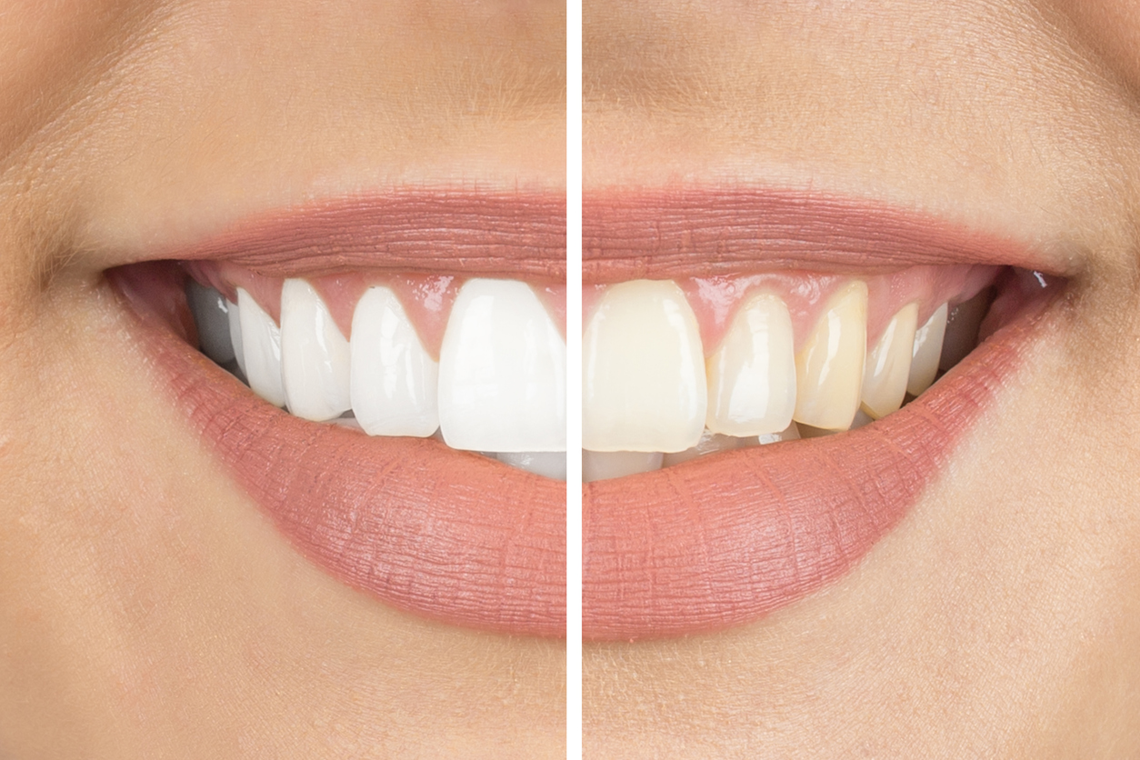 Tips for Teeth Whitening Before- and-after-smile-half-and-half