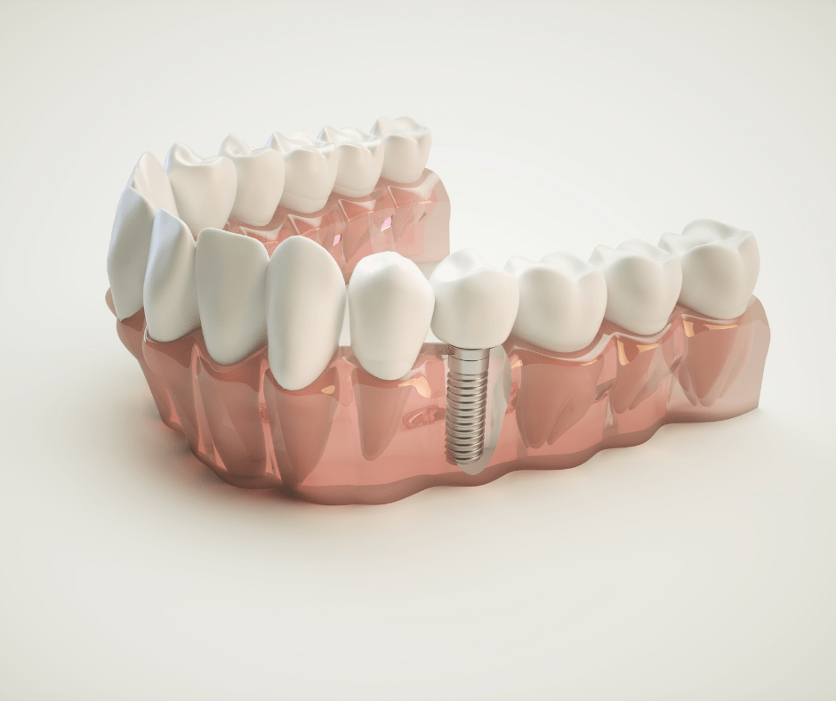 Dental Implant Health for Tooth Replacement