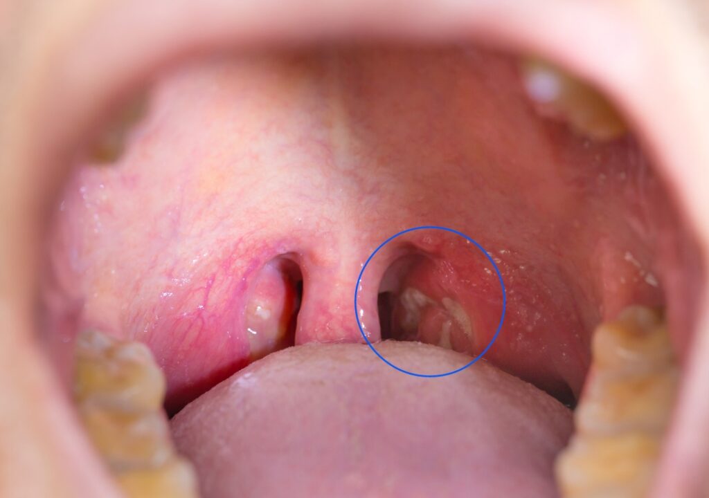 Tonsil-Stone dental issue