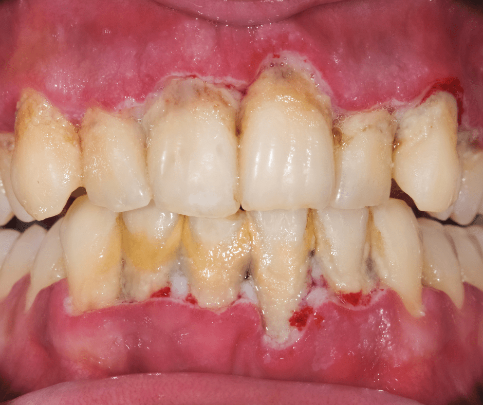 periodontal-disease-1